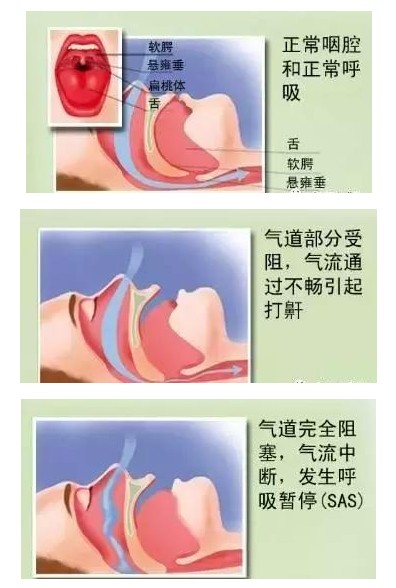 呼吸机可以完全治愈睡眠呼吸暂停吗？